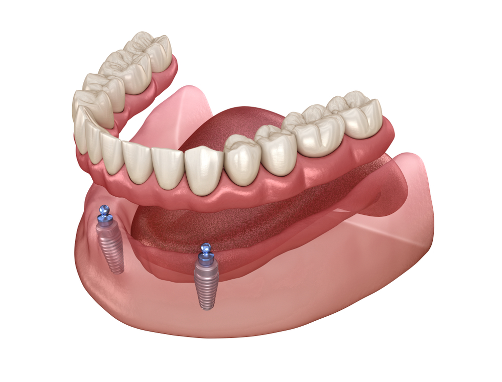 Snap-On Implant Supported Dentures at Smyle East Meadow