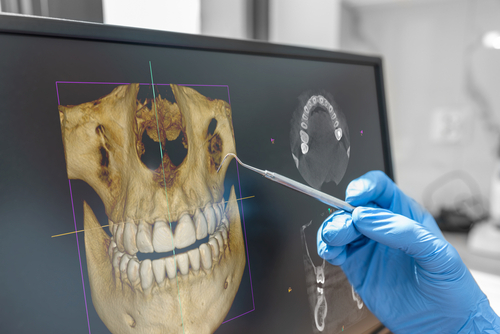 3D CBCT diagnostic imaging used in guided implant planning