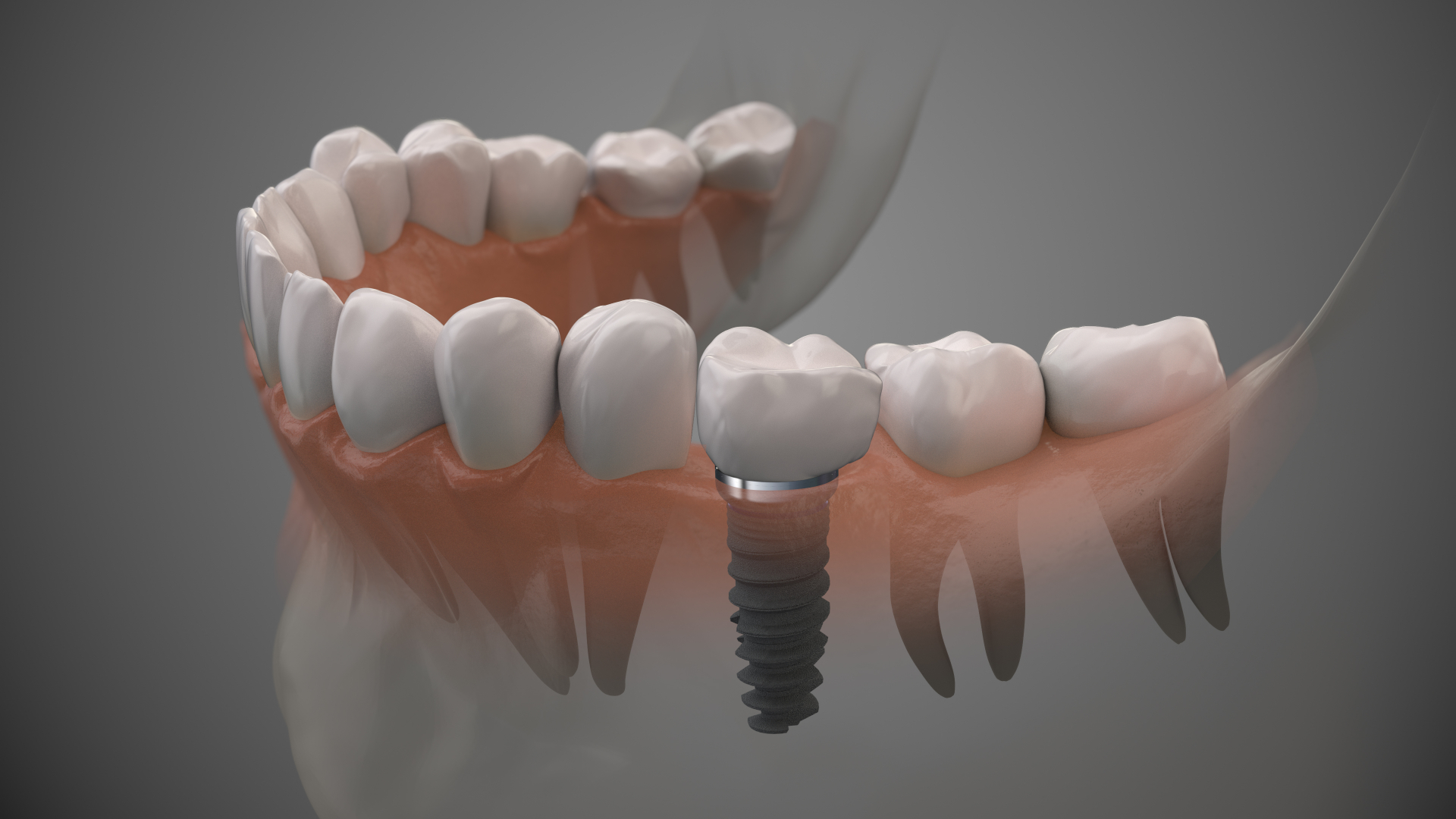 Single Dental
