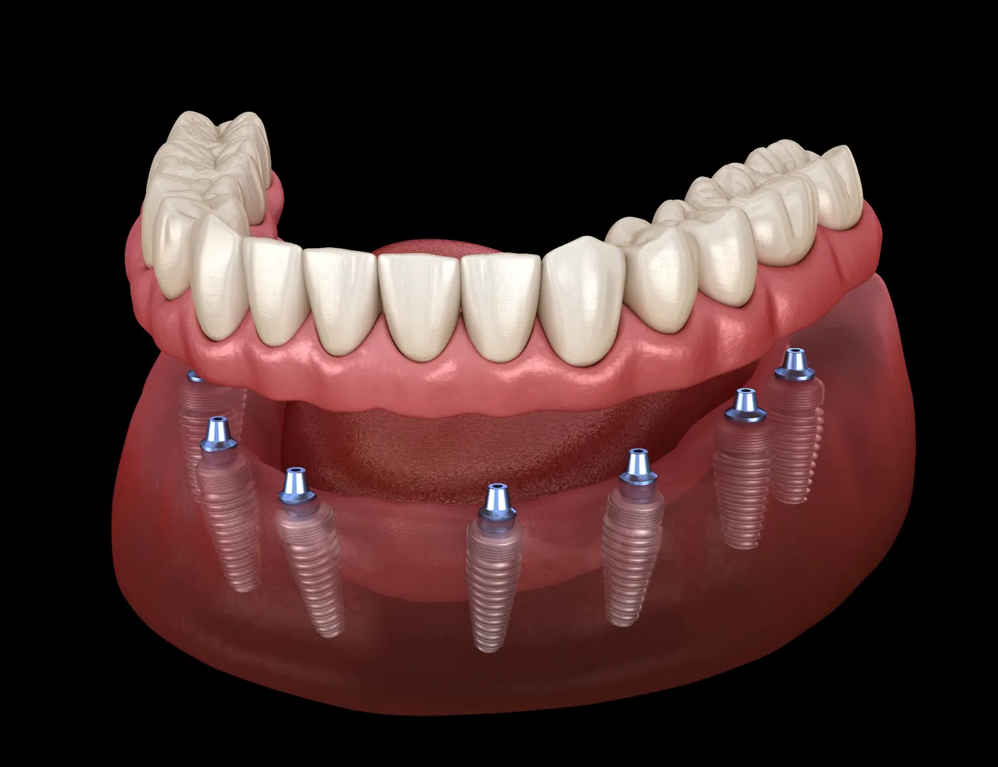 All-On-X Dental Implants at Smyle East Meadow