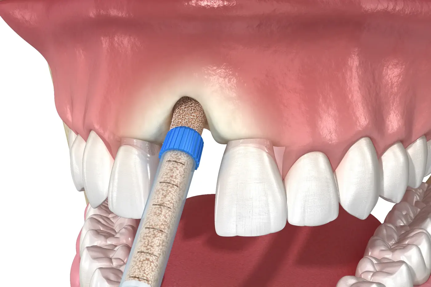 Bone Grafting at Smyle East Meadow