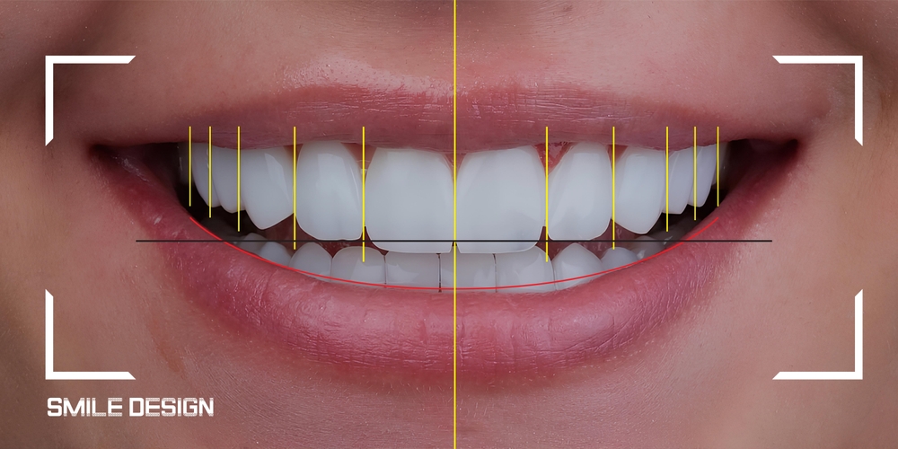 Cosmetic Dentistry at Smyle East Meadow